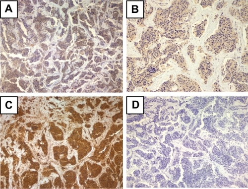 Figure 4 Immunohistochemical staining of pancreatic adenocarcinoma tissue sample from a 77-year-old female patient diagnosed with poorly differentiated adenocarcinoma of the head of the pancreas. A) p1A2 antibody (×40), B) mESL antibody (×100), C) mMDQ antibody (×200), D) p1B3 antibody (×40).