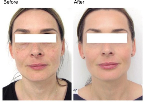 Figure 1 Results before and after RRS® Silisorg, courtesy of Dr Katarzyna Luch.