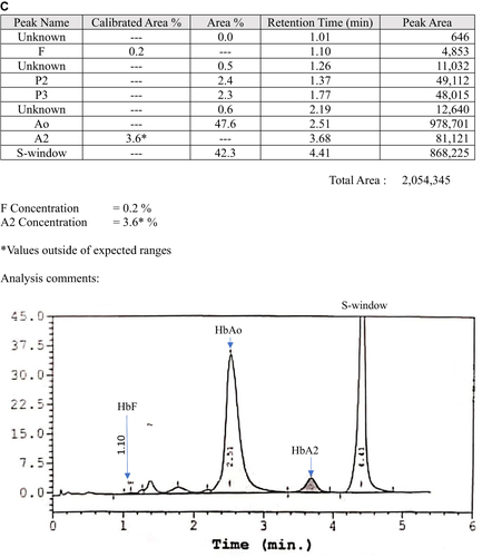 Figure 2 High-performance liquid chromatography (HPLC) analysis of family members of Case 2. (A) Hb E heterozygous father; (B) Hb E heterozygous brother; (C) Hb G-Makassar heterozygous mother.