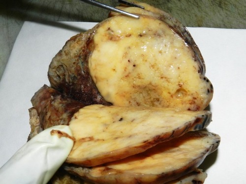 Figure 5 Macroscopic appearance of a pulmonary carcinosarcoma consisting of a large (>10 cm), whitish and fleshy mass with well-demarcated tumor border and heterogenous cut surface.