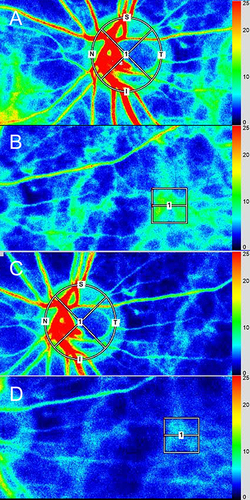 Figure 1 Representative color map images of laser speckle flowgraphy. (A) ONH MBR-vessel before intravitreal injection of brolucizumab. (B) The CHOR MBR before intravitreal injection of brolucizumab. (C) The ONH MBR-vessel 30 minutes after intravitreal injection of brolucizumab. (D) The CHOR MBR 30 minutes after intravitreal injection of brolucizumab.