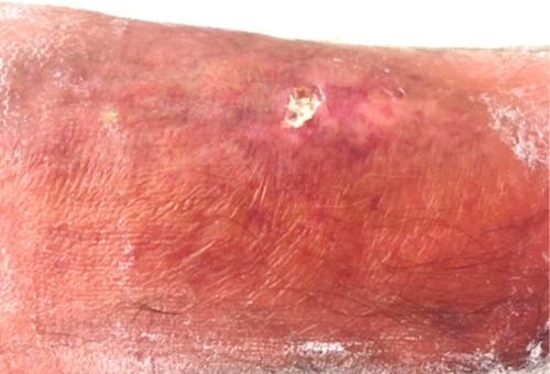 Figure 2 A 12×6 mm pretibial ulcer with a fibrin bed on the linear morphoea lesion and erythema with ill-defined borders.