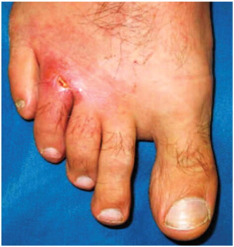 Figure 4. Cutaneous leishmaniasis. Ulcerated plaque on the right fourth toe and third web space. This case has been previously reported. Reprinted with permission from: Pehoushek et al. [Citation51], with permission from Elsevier.