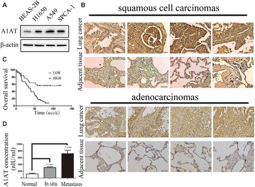 Figure 1 A1AT is overexpressed and correlated with poor prognosis in lung cancer. (A) A1AT is overexpressed in NSCLCs by Western blot. (B) A1AT levels in a human NSCLC tissue microarray by IHC. (C) A1AT is correlated with poor prognosis in lung cancer. Kaplan–Meier analysis of overall survival of 90 non-small cell lung cancer patients. Each subgroup was divided into low- (below or equal to the median value) and high-A1AT expression groups (above the median value); Log rank test, P < 0.001. (D) A1AT is detected by ELISA. A1AT in 63 serum samples of lung cancer patients (42 cases of carcinoma in situ and 21 cases of metastatic cancer) and 20 serum samples of healthy person are detected by ELISA kit (P < 0.001).