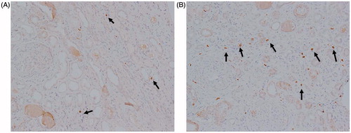 Figure 2. The distribution of MCs in patients with anti-GBM nephritis: immunohistochemical (IH) staining showing CD117 expression in the kidney of patients with anti-GBM nephritis in group 1 (A) and in group 2 (B) (IH, 200×).