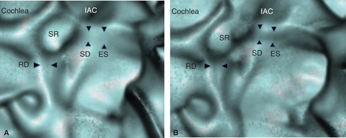 Figure 8. 3D CT views of a cadaver temporal bone. The bony grooves underlining the saccular duct (SD) and the endolymphatic sinus (ES) treated with CaCO3 (A) appear vague compared with those treated with muscle fragments (B). Note the difference in continuity of the bony grooves (arrowheads). IAC, internal auditory canal; RD, reuniting duct; SR, saccular recess.