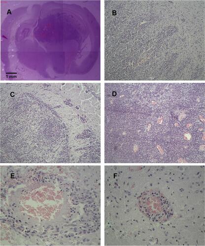 Figure 13 The pathological images of C6 glioma-bearing rats by HE staining. (A) Complete brain pathology, ×4 (phosphate saline). (B) Invasion growth of brain tumor, ×100 (Free EPI). (C) Tumor cells and tumor cell clusters on the edge of the brain tumor, ×100 (epirubicin liposomes). (D) Numerous hemorrhage and necrosis areas in the tumor site, ×10 (epirubicin plus resveratrol liposomes). (E) A reduced cellularity and vacuolated matrix, ×400;(epirubicin plus resveratrol liposomes modified with WGA and MAN). (F) Recurring or residual tumor cell clusters, ×400;(epirubicin plus resveratrol liposomes modified with WGA and MAN).
