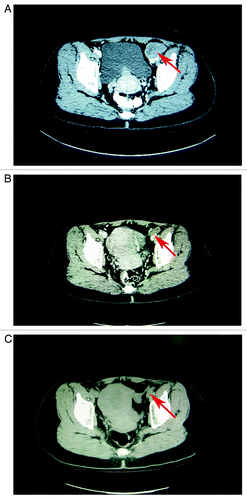 Figure 3. (A) The patient that suffered from unresectable melanoma metastasis to the lymph node beside the iliac blood vessels (shown by the arrow) (B) Shrinking of the lymph node (shown by the arrow), which contained unresectable melanoma metastases following 2 cycles of PGIG treatment (C) The lymph node that had contained metastatic melanoma is hardly visible (shown by the arrow) at a follow-up time of 28 mo.