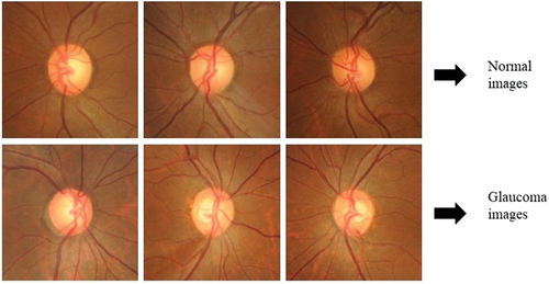 Figure 4. Examples of the ROI in the fundus images cropped around the ONH including RNFL region for both normal and glaucomatous images.