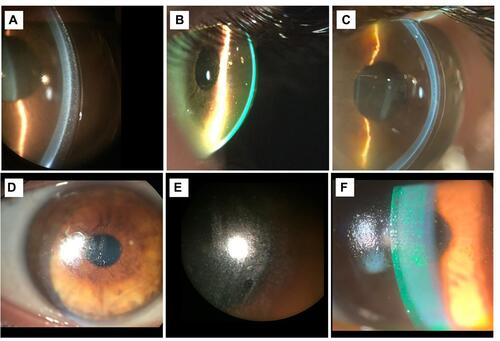 Figure 5 (A) Particles (midday fogging) due to sub-optimal lens alignment; (B) significant presence of particles; (C) milky post-lens fluid reservoir; (D) lipid deposits; (E) poor wettability of SL front surface; (F) SL with front surface debris and scratches. Image credits: (A–E) – Daddi Fadel; (F) – Melissa Barnett.