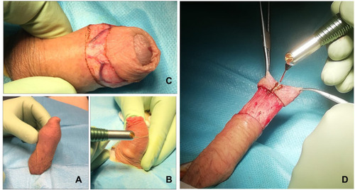 Figure 1 Illustration of the surgical procedure of circumcision using a CO2 laser. (A) Phimosis. (B) The laser beam is used in focused mode to delimit the circumferential mark incision over the penile skin just proximal to the corona. The preputial skin is resected leaving a 0.5 cm sleeve proximal to the corona. (C) Using the laser beam, incisions are made along the marked lines, taking care to cut through the skin to the subcutaneous tissue but no deeper. (D) Between the two top artery forceps (at 11 o’clock and 1 o’clock), the dissecting laser beam is used to make a cut along the middle of the crushed foreskin up to the previously marked incision line.