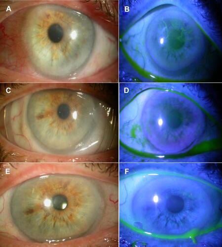 Figure 3 Slit lamp photograph at baseline, post-debridement, and post-cataract. Representative case in the study group showing clinically significant EBMD (A and B). One week after debridement and CAM placement, the ocular surface healed completely without positive or negative fluorescein staining (C and D), and remained stable after cataract surgery (E and F).