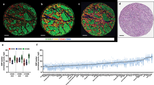 Figure 1. Compartments generated by DSP and an overview of target counts. representative TMA melanoma spot showing the fluorescence image (A) and the compartmentalized image created by molecular compartmentalization (fluorescence colocalization) (B) using GeoMx® DSP. C) Fluorescence image of same spot from serial section using AQUA platform. D) H&E staining of the same spot scanned on Aperio AT2 (Leica). E) Violin plot including DSP counts for CD45, CD68, and S100B on the corresponding compartments/AOIs. F) Mean DSP counts ± SEM in all compartments for each DSP marker. Scale bar, 100 µm.