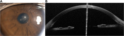 Figure 1 A 19-year-old man with three dense round white infiltrates in the central cornea with cellular reaction in the right eye 5 days after SMILE (A). Oct-optic (cassia) examination of the right eye revealed that the central cornea was cloudy to the cap-stromal bed interface (B).