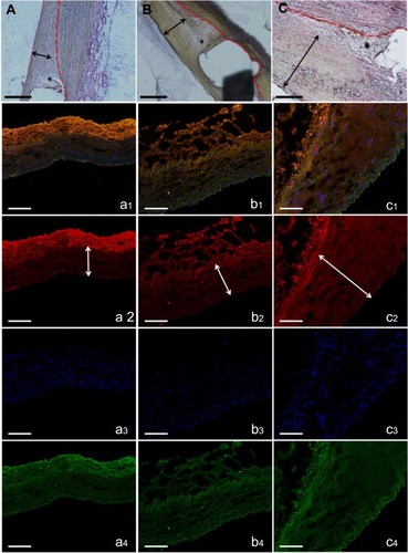 Figure 4 H&E staining of vessel sections after eight weeks (×200). The degradable nanofibrous membranes coated outside of implanted stents were noticed between dotted line and double arrow. Inflammation response was small around stent struts in all groups (asterisk). Groups A (A) and B (B) exhibited almost no neointimal formation, but group C (C) revealed significant neointimal formation with nearly 200 μm thickness (scale bar: 100 μm). Immunofluorescence of type I collagen. Type I collagen (orange) of vildagliptin-eluting (a: high dose and b: low dose) and non-vildagliptin-eluting nanofibrous membrane stent (C). DAPI stained nuclei (blue) and autofluorescence on tunica media (green) are also displayed, respectively. Lower labeling level with collagen type I was detected near drug-eluting stented vessels. Double arrow indicates elastic lamina. Marked neointima hyperplasia owing to the growth of smooth muscle cells in media leads to expression of intima and media regions in group C (c2, double arrow) (scale bar: 100 μm).