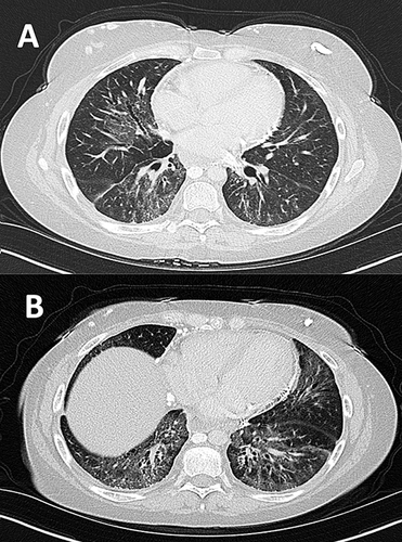 Figure 2 Computed tomographic (CT) Image of Interstitial Lung Disease (ILD) in SSc. (A) Interstitial lung disease (ILD) with bilateral anterior upper lobe reticular opacities and dependent ground glass opacities and bronchiectasis. Central airways are clear. (B) Similar scattered ground glass opacities most predominant in the lower lobes with extensive bronchiectasis and cystic changes.