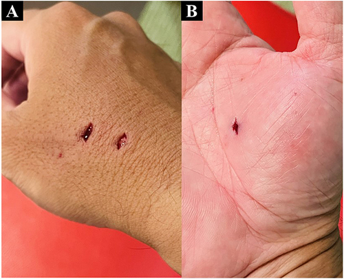 Figure 1 Right-hand wound caused by canine bite (A and B).