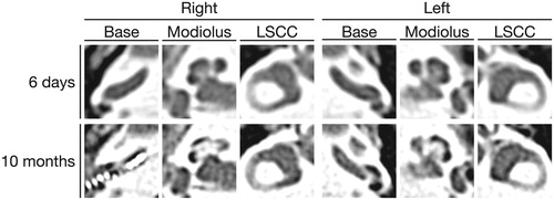 Figure 3. CT of the temporal bones. Axial CT images six days after the onset of hearing loss show the normal appearance of the inner ear bilaterally. Axial CT images of the temporal bone on the first postoperative day which was 10 months after the onset of hearing loss reveal prominent cochlear ossification around the modiolus in both cochleae. LSCC: lateral semicircular canal.