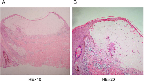 Figure 2 Skin lesions are detected as intraepidermal blisters. (A and B) The top of the blisters is composed of incomplete epidermis with scattered epidermal cells with poor keratosis. A large amount of serous fluid and low lymphocyte, neutrophil, and eosinophil levels are noted in the blisters. Additionally, a significant intracellular and intercellular edema in the lateral wall of the blisters is observed. Lastly, moderate infiltration of mixed inflammatory cells below the vesicle is observed.