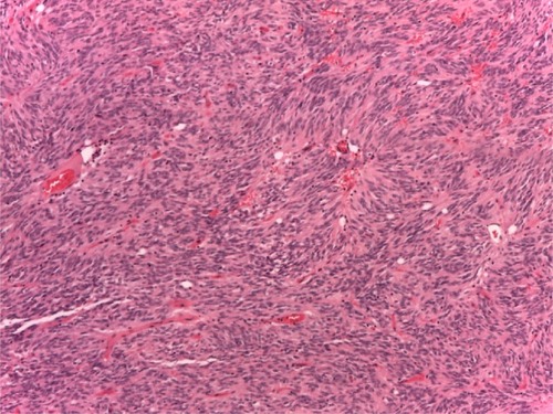 Figure 1 The tumor was composed of a monotonous spindle-cell proliferation.