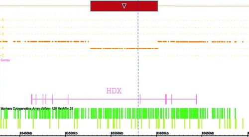 Figure 3.  Representation of the translocation breakpoint on X chromosome using AffymetrixCytogenetics Whole-Genome 2.7M Array. Analysis was performed by Affymetrix GeneChip.Cytogenetics Whole-Genome 2.7M Array using default settings for image analysis, filtration, normalization, and annotation. Visualization of the graphical data was carried out using Chromosome Analysis Suite Software v1.0 software. At the translocated region on X chromosome highly divergent homeobox (HDX) gene is disrupted (represented by arrow).