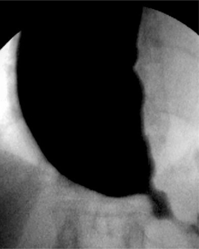 Figure 1 Sliding type hiatal hernia and remarkably dilated esophageal body.