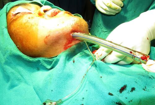 Figure 2 Endotracheal tube has been passed from oral to submental through surgically created tunnel.