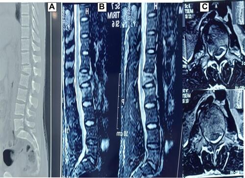 Figure 1 Male patient aged 36 years old with history of road traffic accident, lower limb paraparesis [L1 (lumbar vertebra 1) compressed fracture] more at the right side, AIS grade D, operated on for decompression and fixation, improved after 2 wks to AIS grade E. ((A) sagittal CT scan, (B) sagittal MRI, (C) axial MRI).