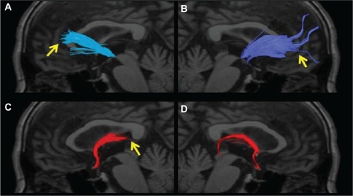 Figure 4 The anterior thalamic radiation superimposed on a T1-weighted sagittal image in an AD patient. (A) No left radiation passing the genu of the corpus callosum and extending into the prefrontal area was depicted (arrow). (B) Only a few nerve fascicles of the right radiation were observed, and depiction was poor (arrow). (C) The left posterior limb of the fornix was not depicted (arrow). (D) The right posterior limb of the fornix was only partially depicted.
