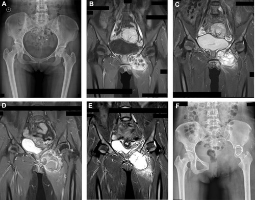 Figure 2 (A) Pelvis X-ray of a 36-year-old female with an osteosarcoma in the pubis. (B) and (C) Fat-saturated T1- and T2-weighted coronal slices of contrast-enhanced MRI showing the maximum diameter of the tumor at the first diagnosis, which showed heterogeneous enhancement, thick septa and obscure boundaries of the tumor. (D) and (E) MRI reevaluation after completion of the neoadjuvant CAI + MSC regimen, showing thin septa, clear boundaries and stable disease according to RECIST 1.1 with a decrease in the tumor diameter. (F) Pelvis plain X-ray of this patient. (The identifiable captions in these images are occluded.).