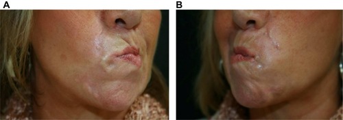 Figure 10 Nodularity that proved to be foreign body granuloma on surgical biopsy.