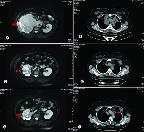 Figure 2. Radiological evaluation before and after treatment.(A) Abdominal MRI revealed irregular mass in right kidney with heterogeneous density and the soft tissue density shadows was seen in the inferior vena cava and right renal vein on 3 October 2022. (B) CT-SCAN revealed multiple enlarged mediastinum lymph node metastasis. (C) Abdominal MRI revealed irregular mass in right kidney with heterogeneous density significant reduction after two cycles of treatment. (D) CT-SCAN revealed significant mediastinum lymph node almost disappeared after two cycles treatment. (E) Abdominal MRI revealed irregular mass in right kidney with heterogeneous density continued reduction after four cycles of treatment. (F) CT-SCAN revealed significant mediastinum lymph node almost disappeared after four cycles of treatment.