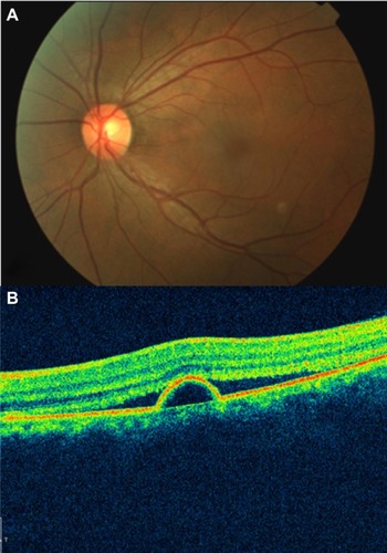 Figure 42 Central serous chorioretinopathy.