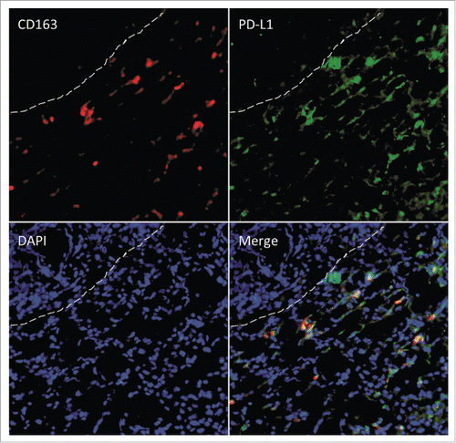 Figure 8. Immunofluorescent double staining for CD163 (red) and PD-L1 (green) at the invasive margin. Dashed lines separate the tumor (top left) from the adjacent liver. DAPI was used as counterstain.