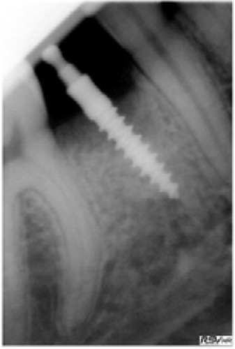 Figure 9 Radiograph during seating of small diameter implant.