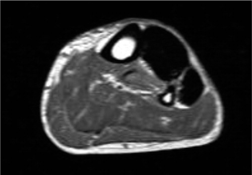 Figure 2. Axial T1 MRI showing low signal intensity in the entire anterior and lateral compartments of the lower leg.