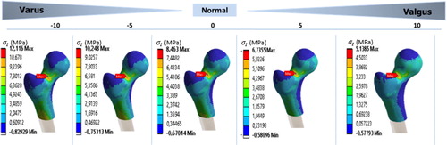 Figure 2. Distribution of the first principal stress component (σI) according to varus / valgus angle.