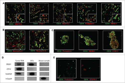 Figure 3. TEM carry a lymphatic phenotype in human breast tumor. The expression of (A) the lymphatic markers VEGFR-2, LYVE-1, VEGFR-3, Podoplanin, and PROX-1 and (B) the VEGFR co-receptors Neuropilin-1 and Neuropilin-2 was examined in breast tumor sections by confocal microscopy. Representative images from minimum five patients; (C) Some TEM formed small cell aggregates (10–100 cells); (D) PROX1 expression analysis was performed by RT-PCR from mRNA isolated from mouse cells (negative control), LEC in culture (positive control) and from TEM (CD14+CD45+ cells) sorted by flow cytometry from dissociated breast tumor. One representative gene expression profile from 10-cell samples from one patient is shown out of 32 cell samples from four patients (8 samples/patient of 10 cells each); (E) Immunofluorescence labeling in sections of non-neoplastic breast tissue adjacent to tumor tissues shows no detectable expression of Podoplanin and VEGFR-3. Non-neoplastic (panel E) and tumor tissue (panel A and C) were stained and imaged simultaneously under the same conditions and thus intensities of the expression of Podoplanin and VEGFR-3 signals can be compared. Scale bars (A-C and E): 25 μm, (A) higher magnification, scale bar: 10 μm.