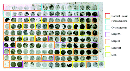 Figure 5. Analysis of Cullin-3 expression in a breast tissue microarray. A breast tissue microarray including 6 normal breast tissues, 6 benign breast tumors and 60 invasive ductal carcinomas was stained for Cullin-3 expression by IHC. Normal breast tissues are indicated in red, fibroadenomas in blue, cystosarcoma phyllodes in aqua, stage 0/I tumors in purple and stage II tumors in orange and stage III tumors in yellow. Tumors were considered positive for Cullin-3 staining if more than 40% of the tissue core showed Cullin-3 staining.