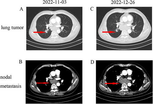 Figure 3 (A and B) Lung mass and nodal metastasis were evaluated as PD compared with CT (12 October 2022). The red arrow in figure A indicates tumors and the red arrow in figure B indicates lymph nodes. (C and D) The lung mass achieved SD, and nodal metastasis achieved PD after two cycles of etoposide combined with cisplatin. The red arrow in figure C indicates tumors and the red arrow in figure D indicates lymph nodes.