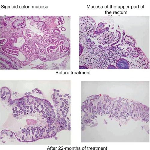 Figure 3 Changes in histopathological findings. Upper pictures, before treatment; lower pictures, after 22-months of treatment.