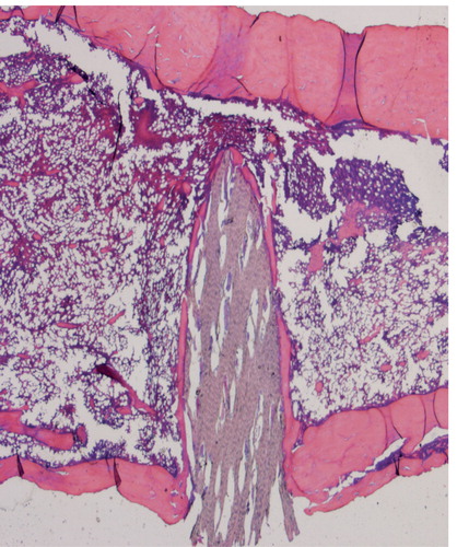 Figure 4. Histology of POGLICO-SHS-UNTR tibia (birch nail, no bisphosphonate). Note the layer of new bone covering the wood.