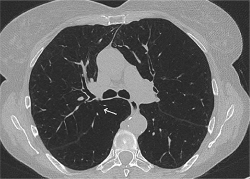 Figure 4 High-resolution computed tomography of a patient with severe emphysema showing an incomplete fissure (↑) on the right and a complete fissure on the left.