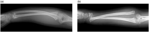 Figure 1. (a, b) Radiographs of the right forearm at the first presentation. Note that true lateral view was not obtained at this point.