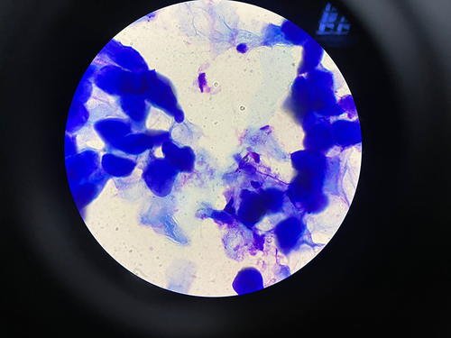 Figure 2 The cytological examination of Tzanck smears with Giemsa staining of white masses taken from skin lesions on the face and neck found round-shaped hyperbasophilic masses (Henderson-Paterson bodies).