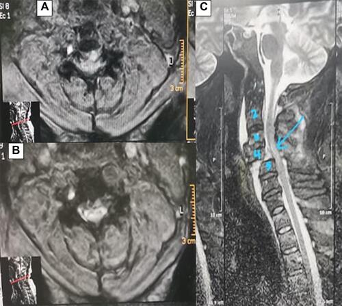Figure 2 Male patient aged 43 years old with history of road traffic accident, patient was quadriplegic at time of examination, AIS grade A, MRI showed C4–5 (cervical vertebrae 4–5) fracture dislocation with corresponding cord contusion seen in the form of hyperintense signal in T2, and patient was operated on for reduction, fixation, and fusion. Patient was followed-up for 6 months with no improvement in his neurological state ((A and B) MRI axial view, (C) MRI sagittal view).