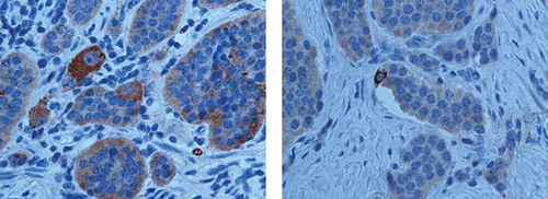 Figure 3. Representative PDGFRα staining in Enterochromaffin (EC) cells with a finely granular positivity with peripheral-membranous enhancement at the vascular pole of neuroendocrine cells.