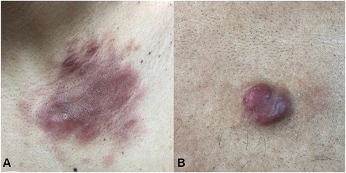 Figure 1 (A) Lesion on the upper left chest showing a poorly demarcated erythematous plaque with infiltrating small nodules over the upper medial border. The plaque is 5.0 cm in maximum diameter × 2.0 cm. (B) Lesion on the upper left back showing a well demarcated erythematous nodule. The nodule is 2.5 cm in maximum diameter × 2 cm.