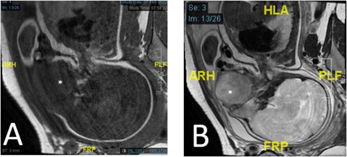 Figure 1. (A) Heterogeneous hypointense lesion (*) on T1 of fetal MRI. (B) Fetal MRI shows mixed signal (*) on T2 with the region of intermediate signal on T2 showing post-contrast enhancement and central hyperintense region on T2 with no enhancement suggestive of the cystic or necrotic component.