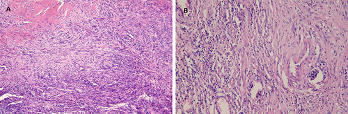 Figure 2 The tumor cells show vascular differentiation containing erythrocytes and mitosis (A)×40, (B)×100).